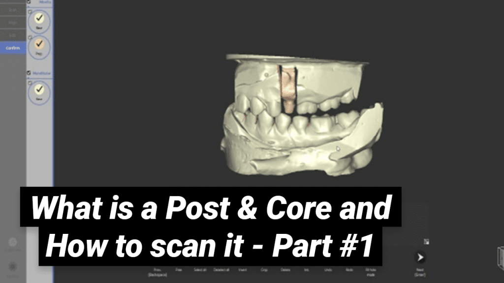 What is a Post & Core and How to Scan It - Part 1
