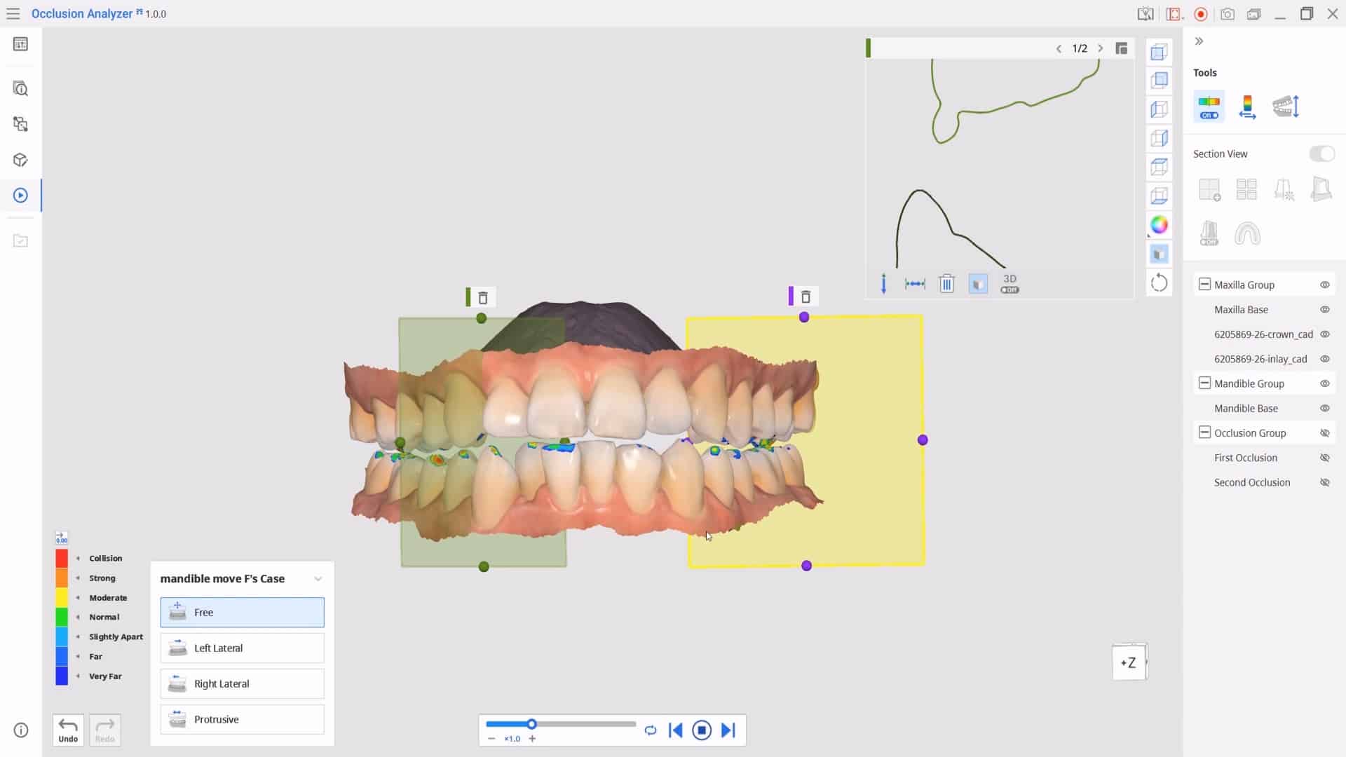 Medit App_ Occlusion Analyzer