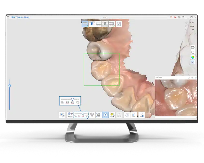 Medit Scan for Clinics I Smart Scan Filtering