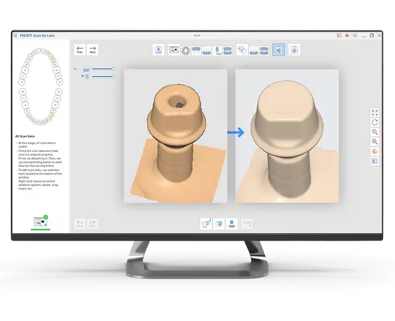 Medit Scan for Labs I Fill holes for abutments