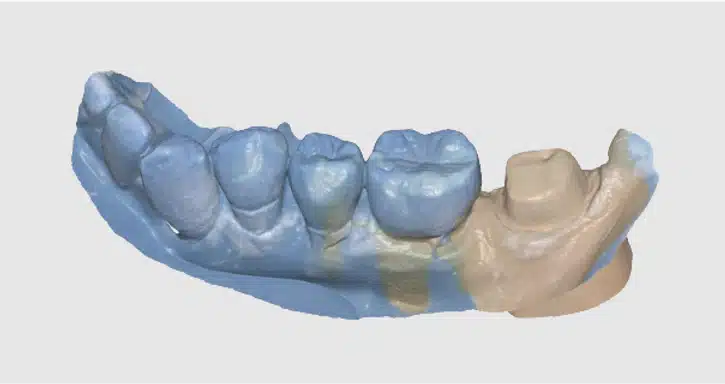 Medit Scan for Labs I Double-sided impression and plaster stump