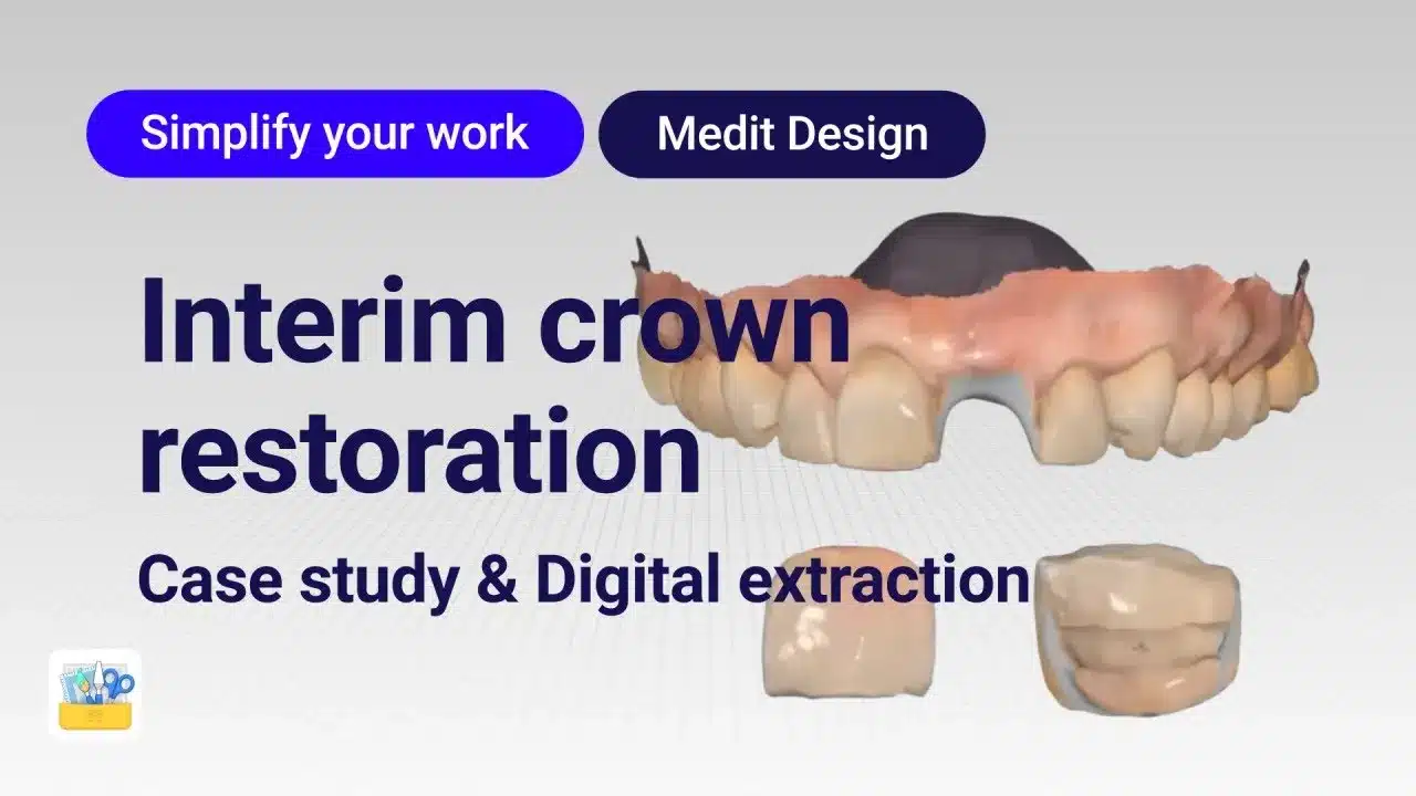 Interim crown restoration – Case study & Digital extraction