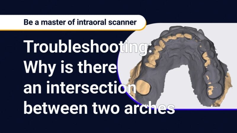 Solving Common Problems in Bite Scan Alignment: Intersections