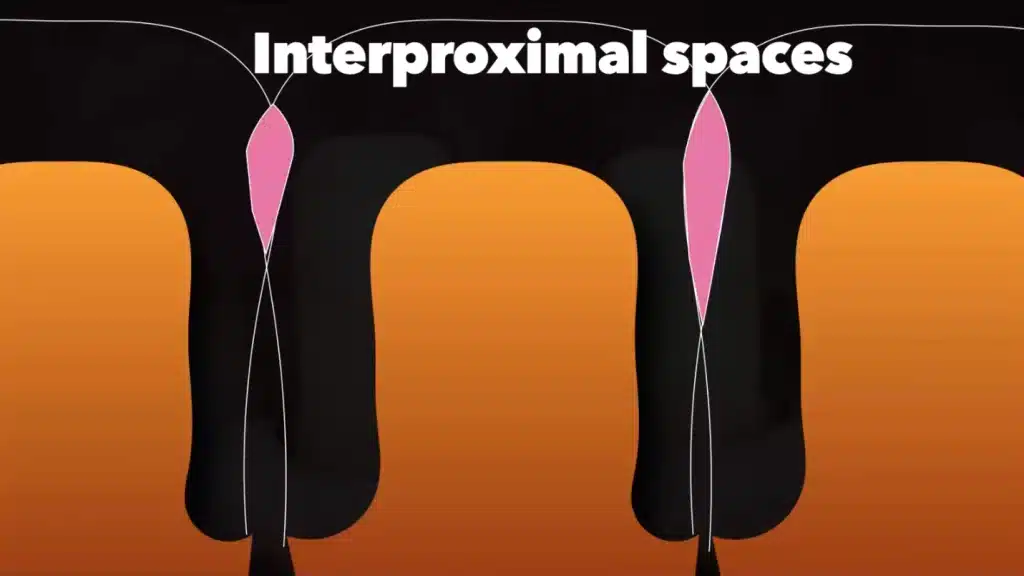 Prep Tips for Digital Impression_interproximal Spaces