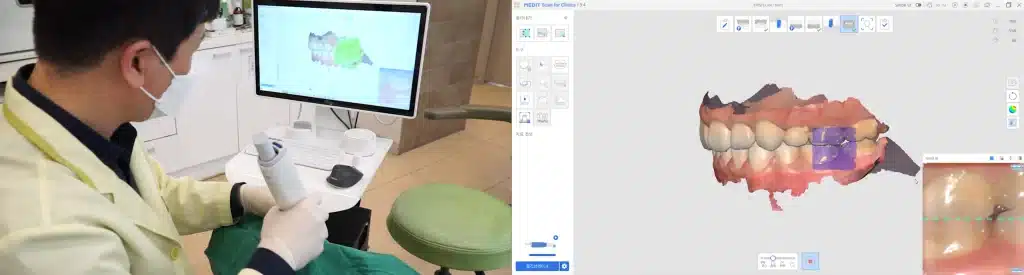 Digital Splint Workflow - Intraoral Scan