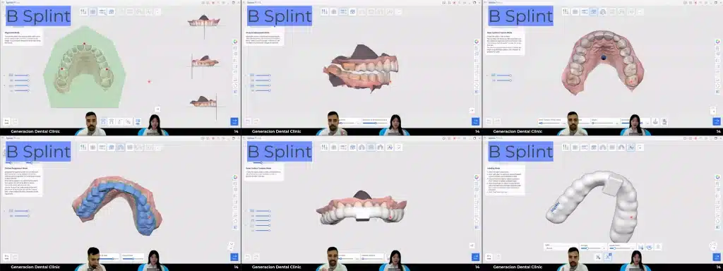 Medit Splints_ B Splint