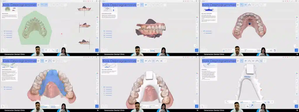 Medit Splints_ Kois Deprogrammer