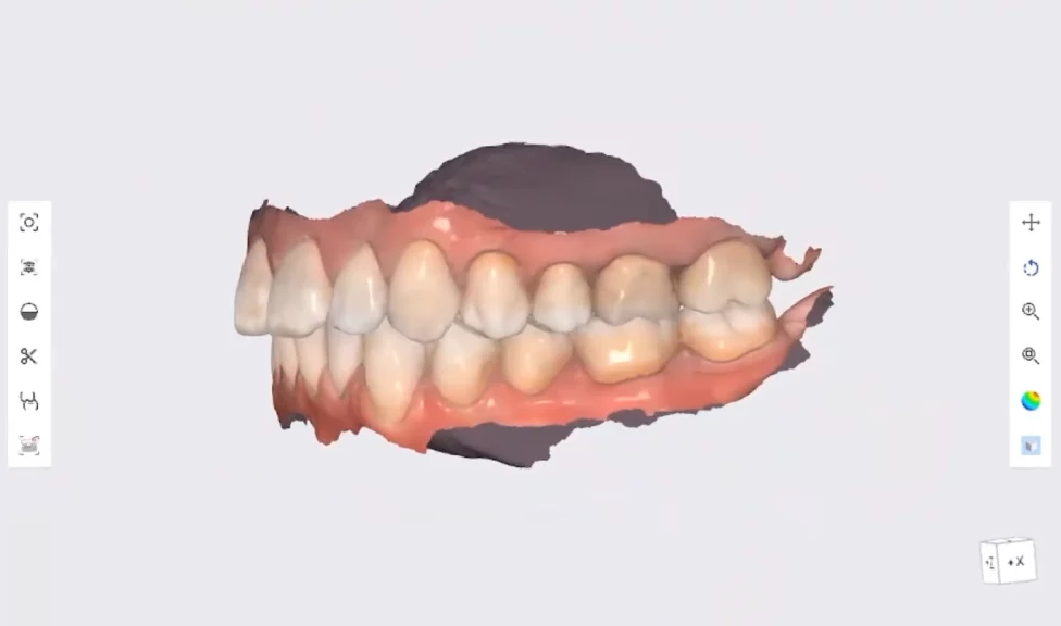 Anterior Bite Splint- Outcome
