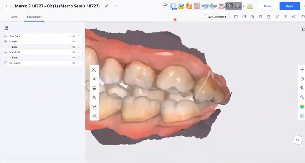 Anterior Bite Splint- After Wearing the Splint