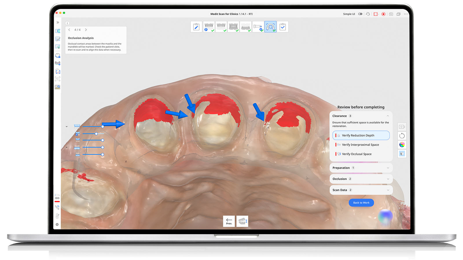 Computador portátil exibindo uma análise da oclusão dentária: três molares superiores destacados em vermelho, com setas azuis indicando as áreas de restauração; barra de ferramentas lateral e um painel “Revisar antes de concluir”.