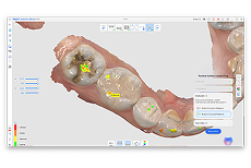 디자인 소프트웨어 내 3D 치과 모델의 스크린샷으로, 노란색 주석 표시기가 표시된 하악과 열린 도구 메뉴가 보여진다.